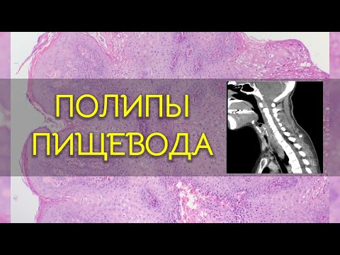 Видео: Полипы пищевода | Патология
