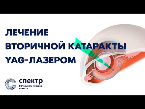 Видео: Вторичная катаракта - катаракта после замены хрусталика. Почему возникает и что делать?