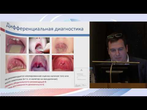 Видео: 4 Свежие клинические рекомендации по диагностике и лечению острого тонзиллофарингита.