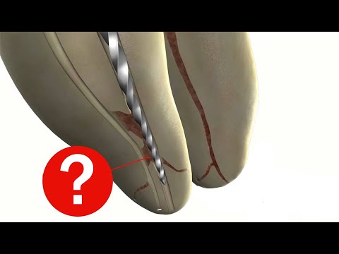 Видео: Эндодонтия - техника краун даун, торсионная, циклическая нагрузки, формирование доступа