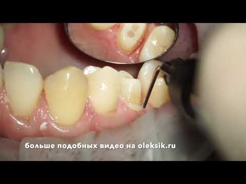 Видео: 15 зуб, препарирование,моделирование временной коронки версия для вк