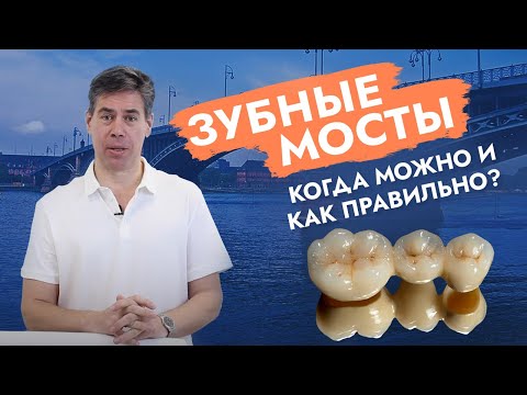 Видео: Зубной мост. Мостовидный протез.