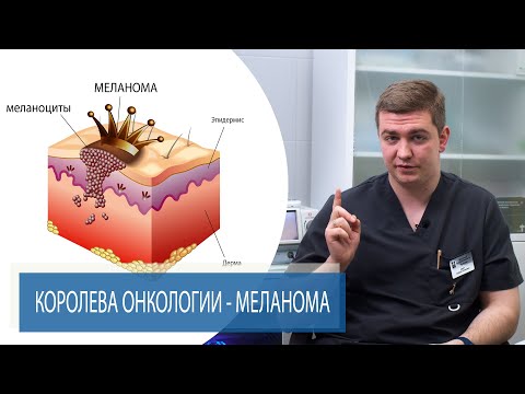 Видео: МЕЛАНОМА |  Королева онкологии | рак кожи