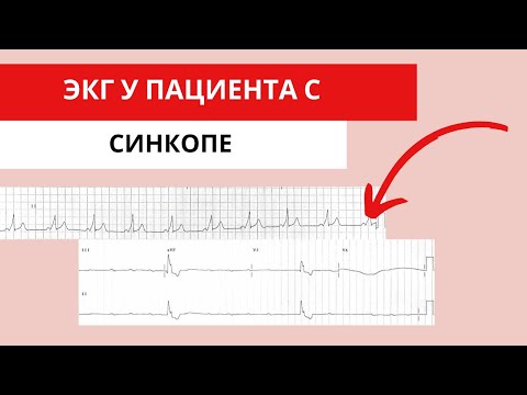 Видео: ЭКГ у пациента при ОБМОРОКЕ (СИНКОПЕ). Какие причины?