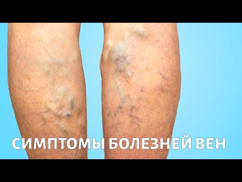 Видео: Болезни ВЕН: сосудистые звездочки, варикоз, трофические язвы