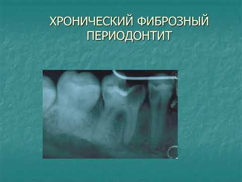 Видео: периодонтит постоянных зубов с несформированными корнями