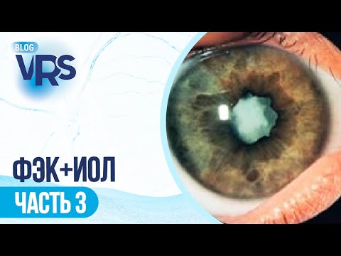 Видео: Хирургия катаракты / Увеит
