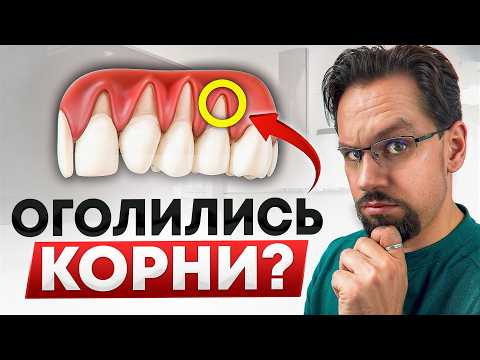 Видео: ОПУСТИЛАСЬ ДЕСНА? Вот что нужно сделать, пока не стало СЛИШКОМ ПОЗДНО