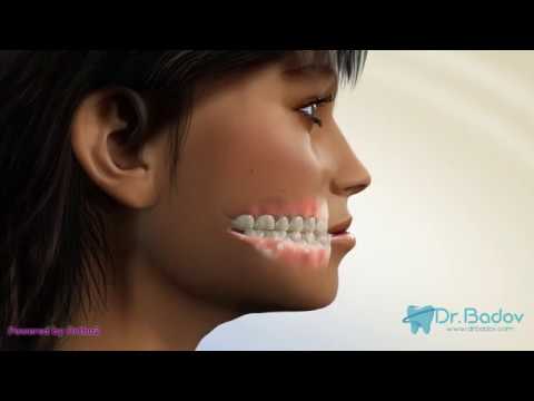 Видео: #ортодонт #брекети #обратназахапка Ортодонтско лечение на обратна захапка