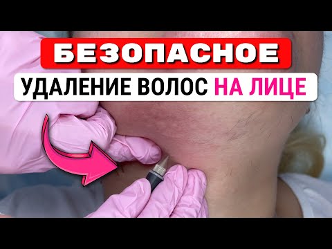 Видео: Урок №57. Электроэпиляция на лице: как безопасно удалить волосы на лице?