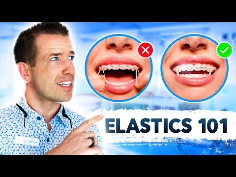 Видео: Полное руководство по резинкам | Braces Elastics