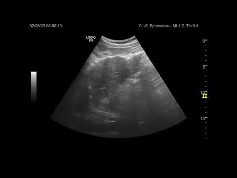 Видео: Ультразвуковая диагностика (УЗИ). Доктор Иогансен. Видеопримеры. Выпуск 54. Цирроз печени.