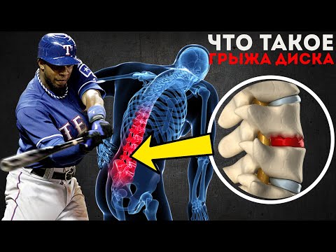 Видео: Что такое грыжа диска? | Просто о самой частой патологии позвоночника | Мамедыч