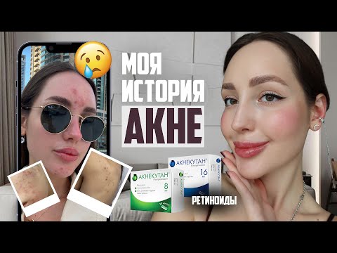 Видео: КАК Я ВЫЛЕЧИЛА АКНЕ | Ретиноиды | побочные эффекты | Моя история