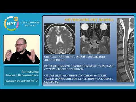 Видео: Очаговые изменения спинного мозга