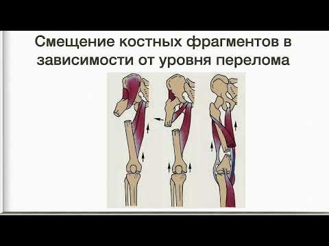 Видео: 32. Переломы диафиза бедренной кости. Клиника, диагностика, лечение