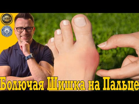 Видео: Растет болючая шишка на пальце ноги! Пяточная шпора, панкреатит, поджелудочная