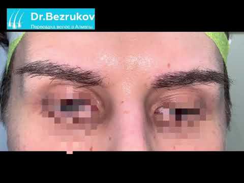 Видео: Клиника Dr.Bezrukov .Пересадка бровей.