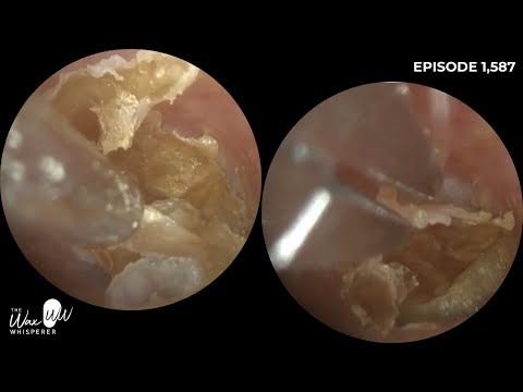 Видео: 1,587 - Очень зудящее ухо