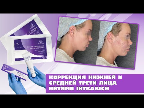 Видео: Мастер-класс имплантации спиральных нитей и нитей с насечками INTRARICH в одну процедуру.