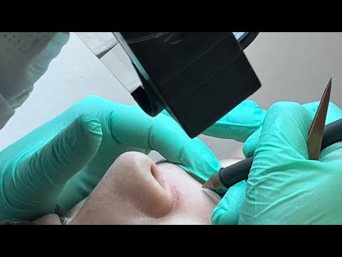 Видео: 4 важных правила в электроэпиляции.