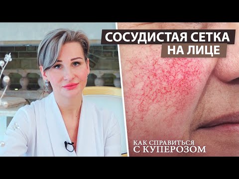 Видео: Купероз и его причины | Сосудистая сетка | Уход за кожей