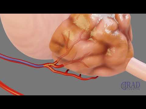 Видео: Эмболизация артерий предстательной железы при доброкачественной гиперплазии предстательной железы