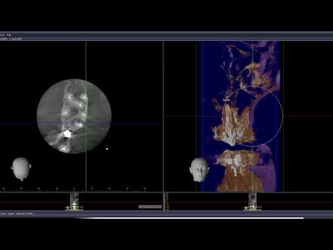 Видео: Одонтогенный гайморит   синусит