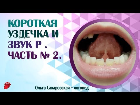 Видео: Короткая уздечка языка и звук Р. Ставим одноударный звук Р. Часть № 2