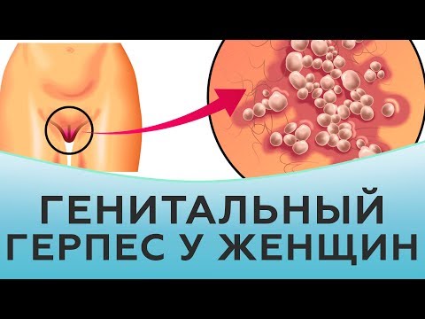 Видео: Генитальный герпес у женщин