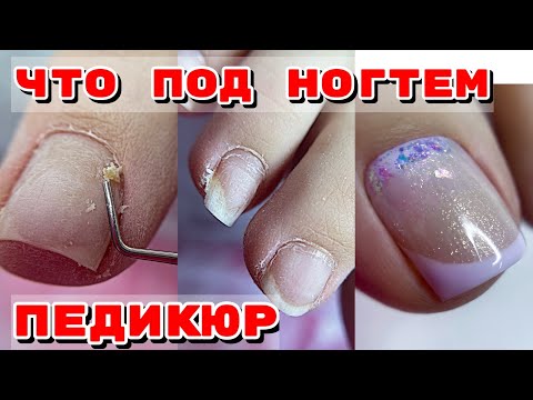 Видео: ОГРОМНЫЕ ПОДНОГТЕВЫЕ МОЗОЛИ 😧 Длиннющие ногти 💅 Педикюр френч
