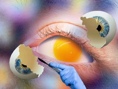 Видео: Вебинар "Осложнения лентикулярной хирургии профилактика, методы лечения и коррекции"