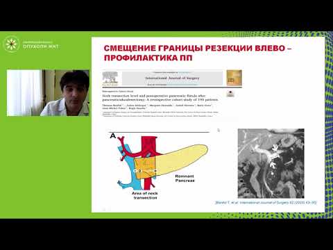 Видео: Специфические осложнения после панкреатодуоденальной резекции