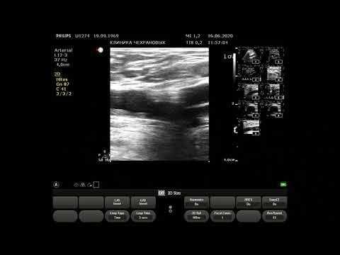 Видео: УЗИ артерий нижних конечностей U 1274 2020 06 16 11 46 30