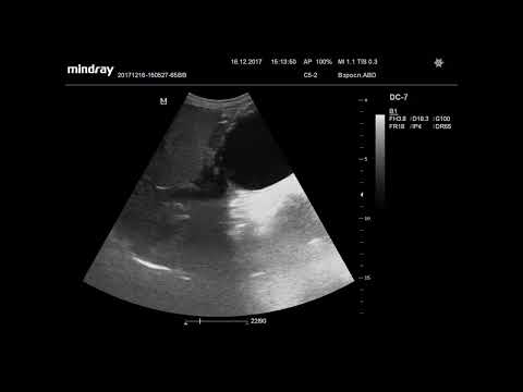 Видео: Ультразвуковая диагностика. Доктор Иогансен. Видеопримеры. Выпуск 5. Киста поджелудочной железы.