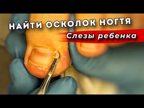 Видео: Плакал, но доверял. История вросшего ногтя у ребенка 10 лет #подология