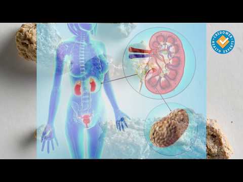 Видео: Д-р Тодор Пепелджийски за камъните в бъбреците
