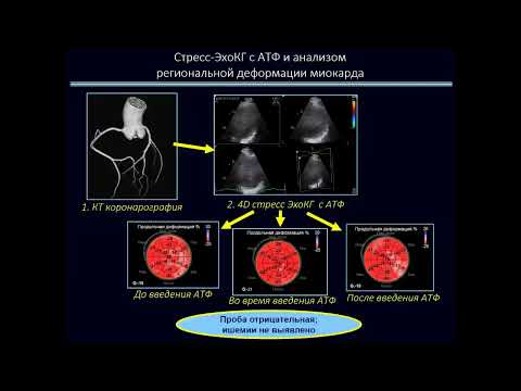 Видео: ЭхоКГ в выявлении ишемии при отсутствии значимого поражения магистральных коронарных артерий.
