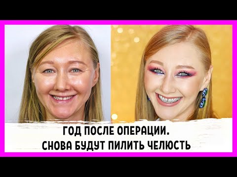 Видео: Мне снова будут пилить челюсти. Возможности пластической хирургии! До и после!