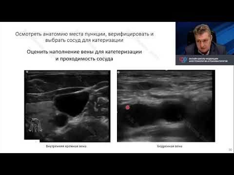 Видео: УЗИ сосудистый доступ при ожогах Лахин Р.Е.