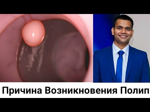 Видео: Полипы - Причина Возникновения Полип И Их Лечения