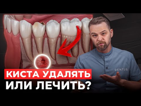 Видео: Киста зуба: лечить или удалять?