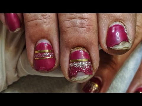 Видео: ЖУТКИЕ ОТСЛОЙКИ 😨😲 ОНИХОЛИЗИС 😣новогодний дизайн ногтей  / укрепление акриловой пудрой