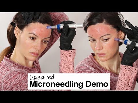Видео: Микронидлинг в домашних условиях — СОВЕТЫ, ПРЕДУПРЕЖДЕНИЯ И ДЕМОНСТРАЦИЯ