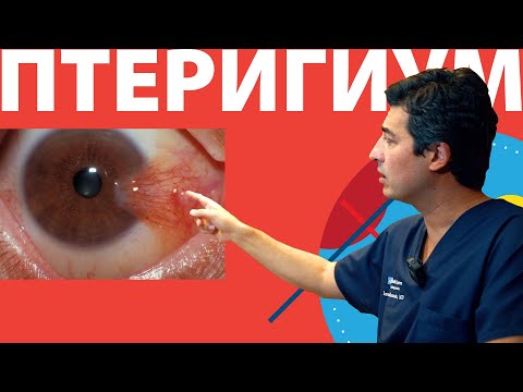 Видео: ПТЕРИГИУМ что это такое? Причины, осложнения и лечение