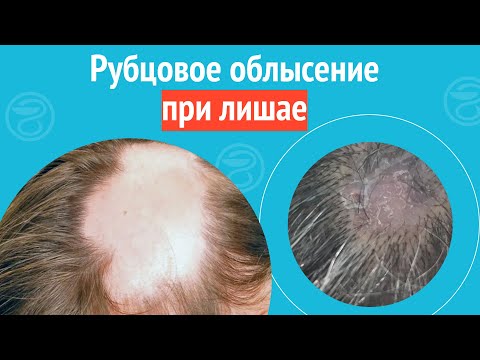 Видео: 😩 Рубцовое облысение при лишае. Клинический случай №1180