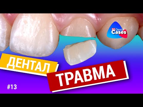 Видео: Дентальная травма. Дентал кейсы от BG #13