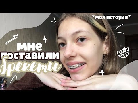 Видео: мне поставили брекеты 🦷// вся правда и моя история