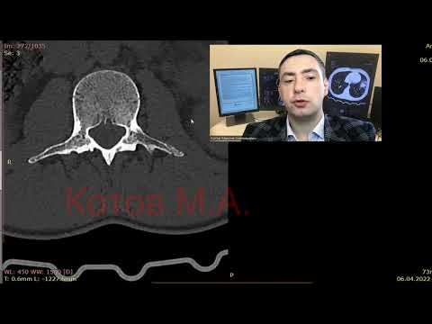 Видео: Перелом поперечных отростков, сакрализация L5. Ролик №42