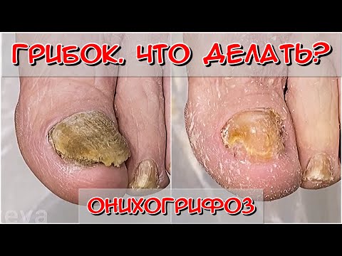 Видео: Грибок ногтей / Толстый ноготь / Ноготь желтый / Ноготь пожелтел что это? / Грибок ногтей на ногтях